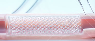 Gastrointestinal Stent Market